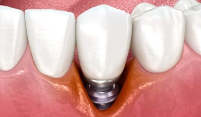 Peri-implantite e doenças sistêmicas