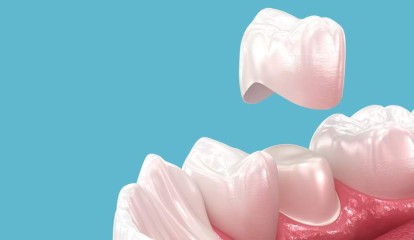 Preparos dentais em prótese fixa