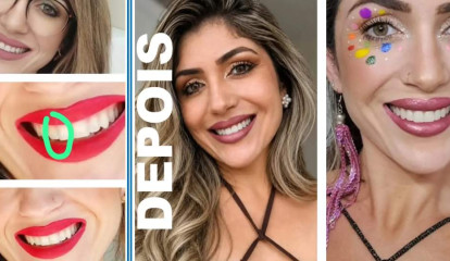 Professora da Univali Be Dental School recupera sorriso de paciente após quebras frequentes em restaurações