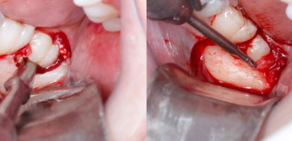 Cirurgia Oral