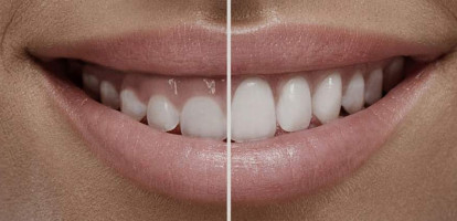 Cirurgia Plástica Periodontal e Peri-implantar